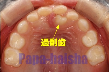 過剰歯と診断されたらココをみて下さい パパはこどもの歯医者さん