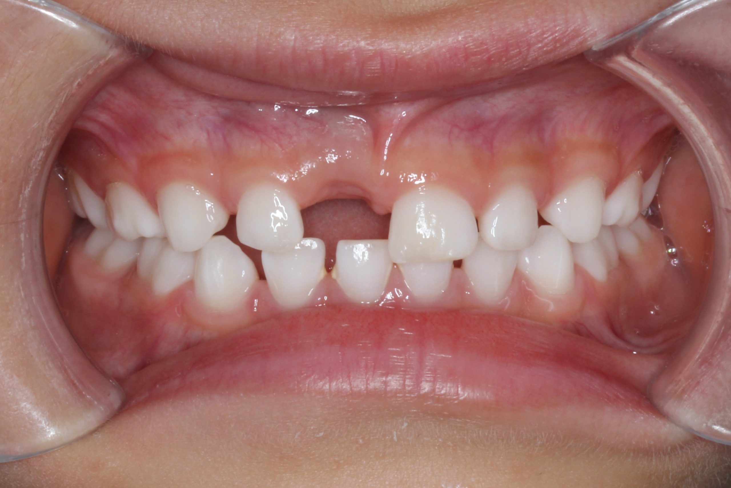 子供 前歯 ぶつけ た 乳歯