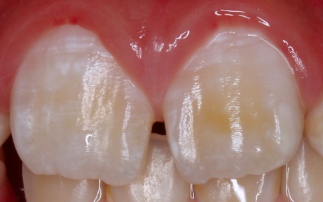 エナメル形成術は保険適用されますか?